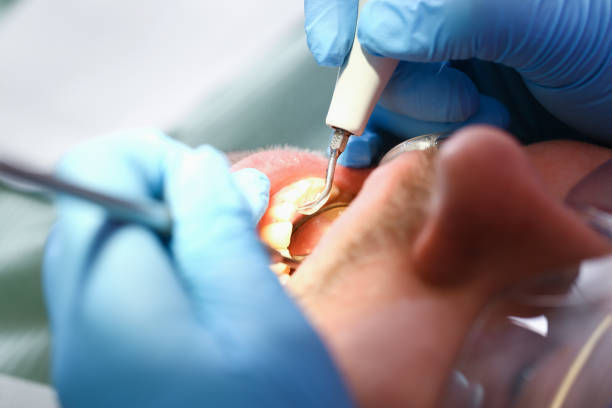 Best Emergency Dentist for Knocked-Out Tooth in Castle Pines, CO